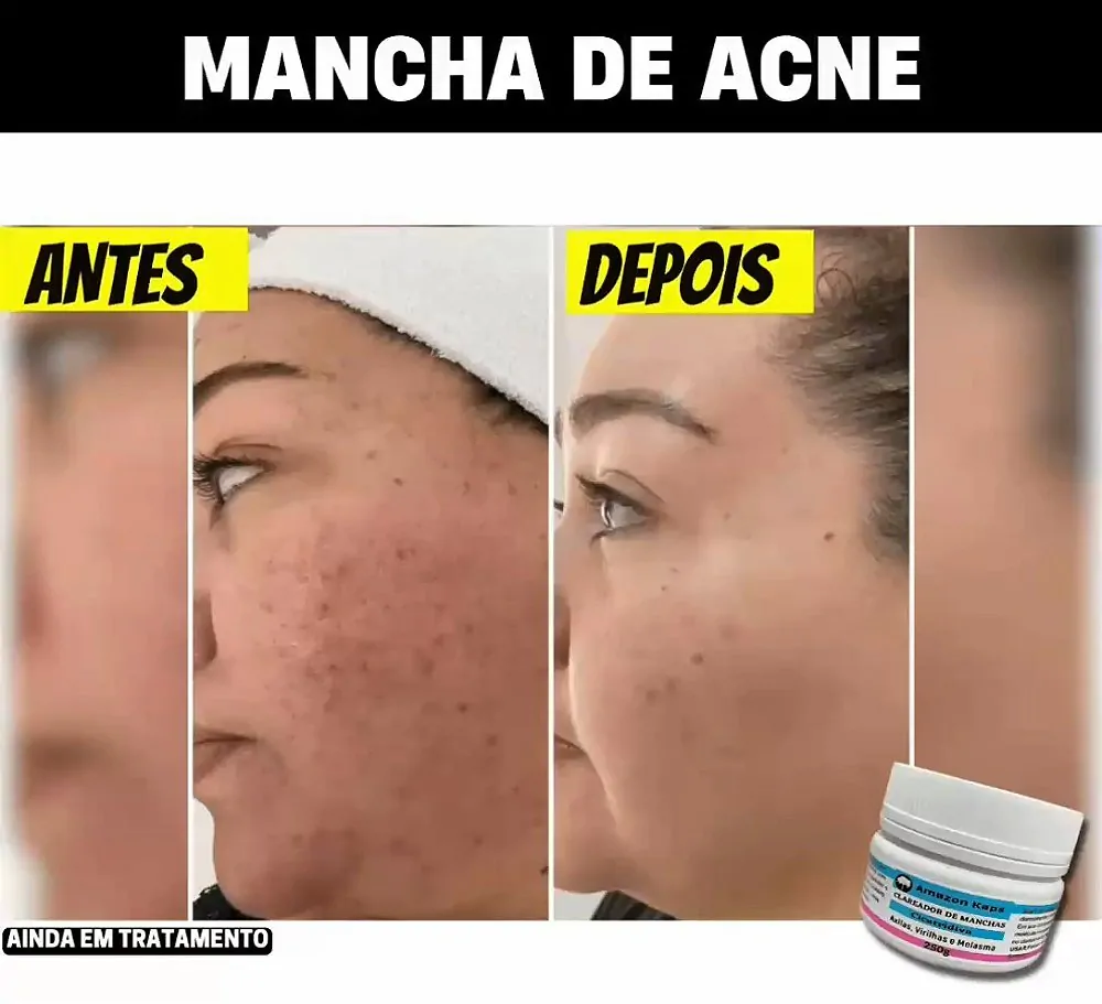 Resultado Amazolé – Antes e Depois
